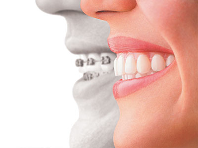 The image features a split-screen graphic with a woman s smiling face on the left side and a dental implant on the right, suggesting the transformation of a smile through dental work.