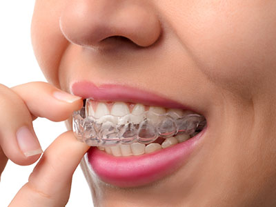 The image shows a person with their teeth covered by clear braces, holding a small object close to their mouth.