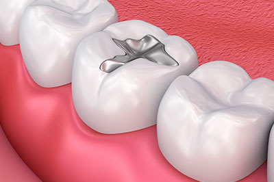 The image displays a close-up view of a dental implant integrated into a human tooth, set against the background of a healthy oral cavity with visible gums.