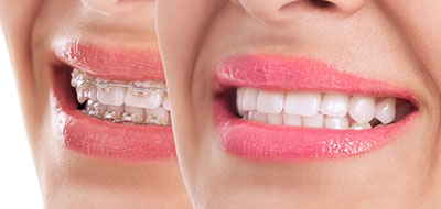 The image features a close-up of a person s face with a focus on their teeth, which are enhanced with braces, and lips, which are painted pink.