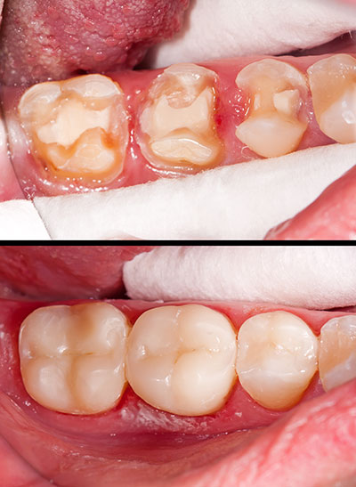 The image shows a close-up view of an open mouth with teeth, including a set of dentures, and gums with signs of inflammation and dental issues, likely before and after treatment or comparison of oral health states.