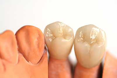 The image shows two artificial teeth with visible enamel detailing, placed side by side against a white background.