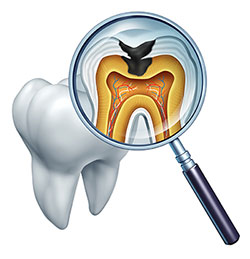 The image shows a magnified view of a tooth with an open crown, revealing the interior structure including pulp chamber and nerve endings, set against a background that appears to be a cross-sectional view of a tooth s root system, all viewed through a magnifying glass.