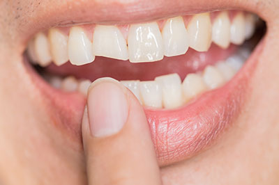 The image shows a close-up of a person s mouth with teeth, holding their finger near their lips, which are parted in a smile.