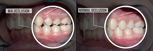 The image displays a side-by-side comparison of two dental implants with annotations highlighting differences between them, likely for educational purposes.