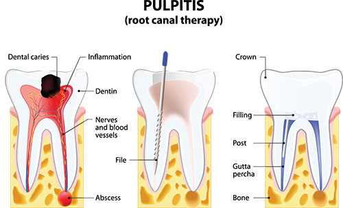 The image shows a detailed diagrammatic illustration of a human tooth with its root canal therapy process labeled, highlighting dental caries, infection, dentin, filling, and the use of an instrument for treatment.