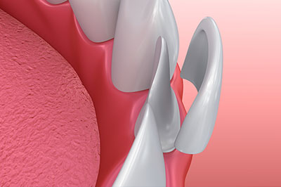 The image shows a close-up view of a dental implant with a metal screw, set against a background that appears to be a medical environment with a pinkish material that could be a tongue or palate.