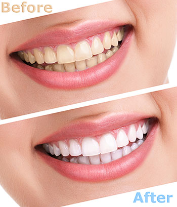 The image displays a side-by-side comparison of a person s teeth before and after dental treatment, showcasing the improvement in tooth color and whiteness.