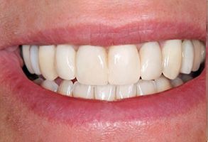 The image shows a close-up of a person s smiling face with a focus on their teeth, which are clean and white.