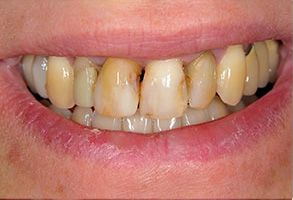 The image features a close-up of a person s teeth with visible staining, which appears to be a before-and-after photo comparing dental health.